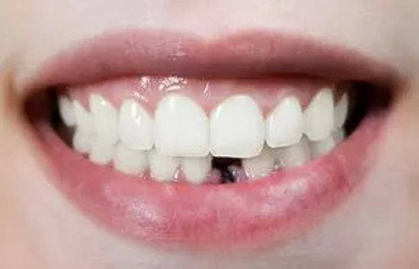 Ako zistím či som vhodný kandidát na zubné implantáty?