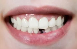 Ako zistím či som vhodný kandidát na zubné implantáty?