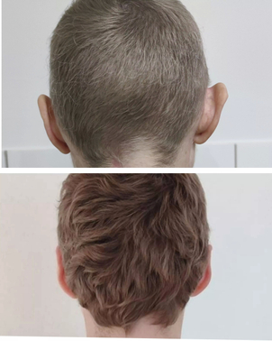 Fotografie pred a po otoplastike