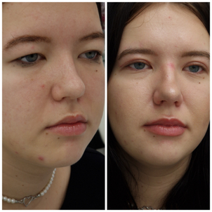 Blefaroplastiku môžu podstúpiť aj mladší klienti s genetickou predispozíciou