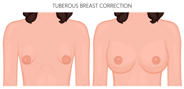 Tubulárny tvar prsníka