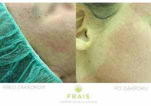 Pred a po frakčnom laserovom resurfacingu