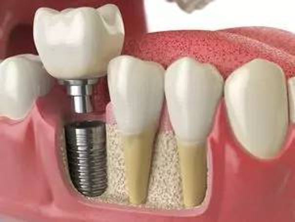 Čo sú zubné implantáty?
