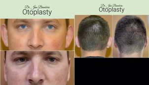 Výsledok otoplastiky