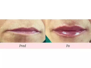 Klasické chirurgické zväčšenie pier