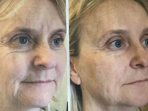 Aké poznáme lekárske ošetrenia laserom