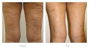 Čo je celulitída a prečo vzniká