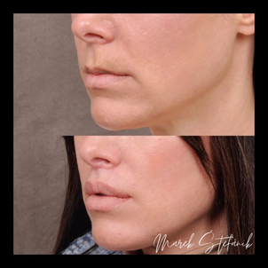 Čo je lifting pier?