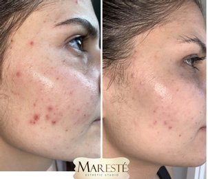 Výsledok liečby akné