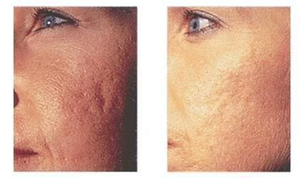 Pred a po chemiskom peelingu