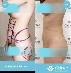 Konzultácia a príprava pred liposukciou