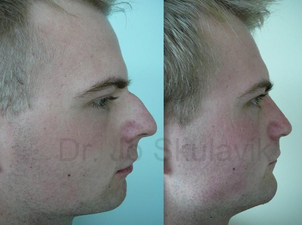 Operácia nosa - Rhinoplastika