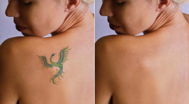Čo je laserové odstránenie tetovaní a pigmentácií