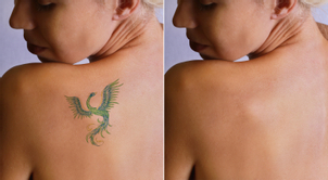 Čo je laserové odstránenie tetovaní a pigmentácií