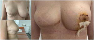 Rekonštrukcia prsníka