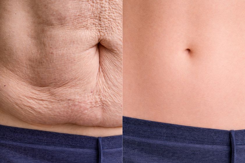 Abdominoplastika