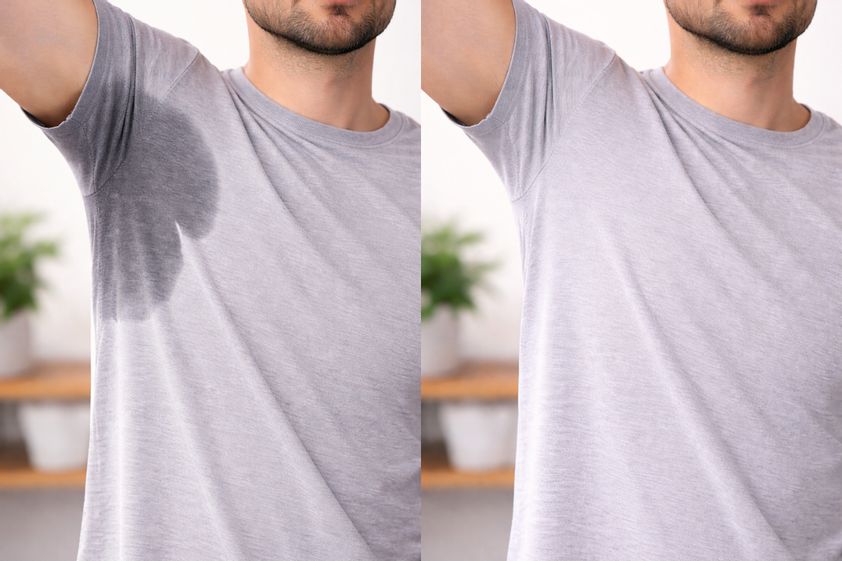 Nadmerné potenie