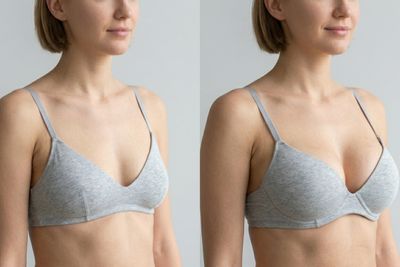 Pred a po Lipofilling prsníkov