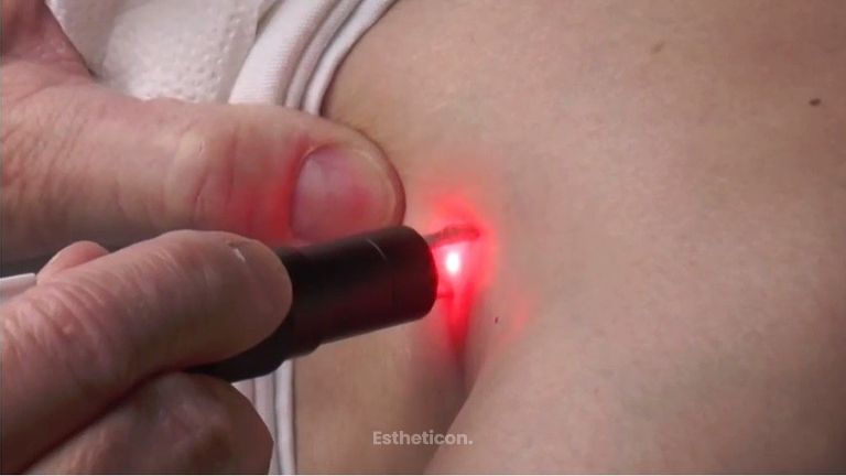 Jalčovík laserové ošetrenie cievok