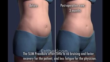 SlimLipo animácia
