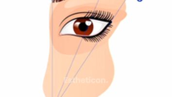 Dolná blefaroplastika