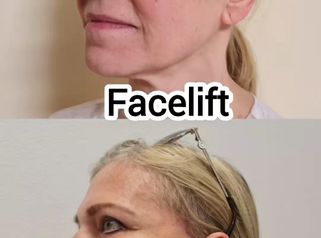 Facelift MUDr. Ján Zeleňák