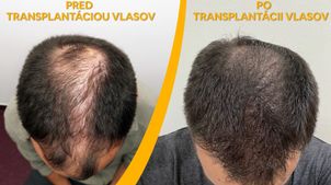 Výsledky transplantácie vlasov