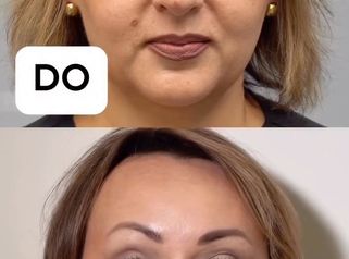 Botox do a po Doktorpro