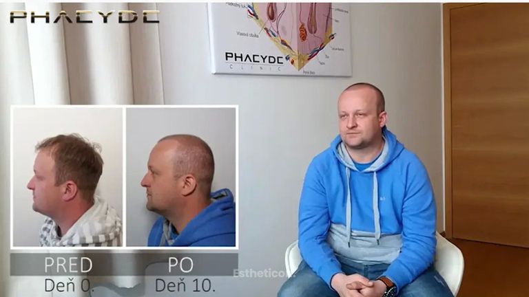 Transplantácia Vlasov - PHAEYDE Clinic