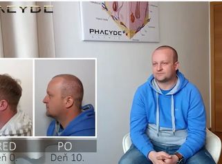 Transplantácia Vlasov - PHAEYDE Clinic