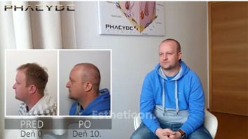 Transplantácia Vlasov - PHAEYDE Clinic