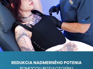 Redukcia nadmerného potenia pomocou botulotoxínu