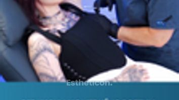 Redukcia nadmerného potenia pomocou botulotoxínu