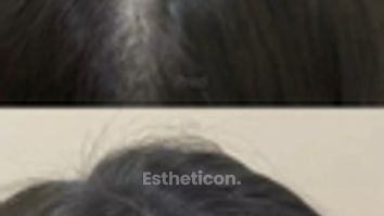 Vlasová mezoterapia