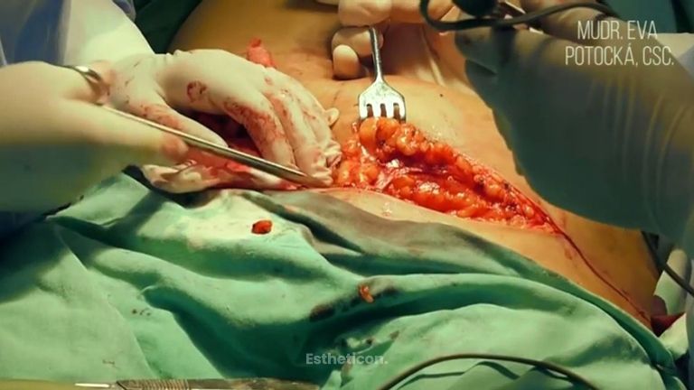 MUDr. Eva Potocká, CSc. - Abdominoplastika 