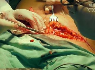 MUDr. Eva Potocká, CSc. - Abdominoplastika 