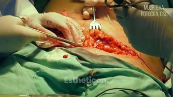 MUDr. Eva Potocká, CSc. - Abdominoplastika 