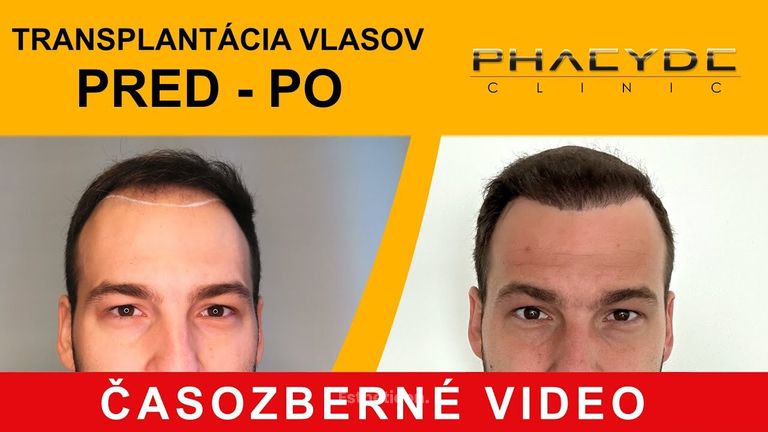 Transplantácia vlasov pred po: Matúš (Časozberné video) - PHAEYDE Clinic