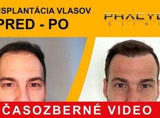 Transplantácia vlasov pred po: Matúš (Časozberné video) - PHAEYDE Clinic