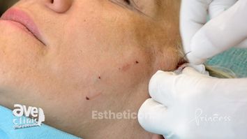 Mezonite - niťový lifting značky Princess ® Lift / Thread-Face Lift