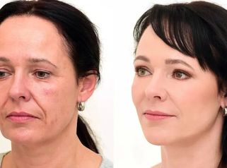 Premena pani Dagmar na Klinike YES VISAGE - operácia očných viečok a omladenie tváre