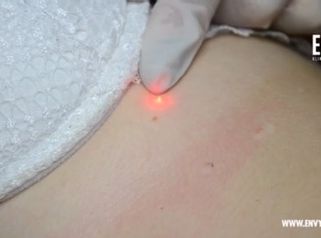 Laserové odstraňovanie znamienok, výrastkov a bradavíc