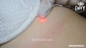 Laserové odstraňovanie znamienok, výrastkov a bradavíc