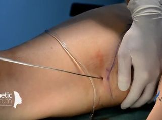 Liposukcia Vaser Lipo 