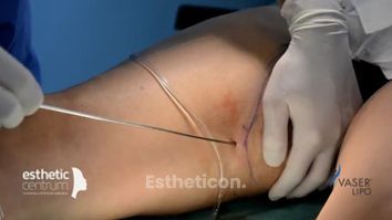 Liposukcia Vaser Lipo 