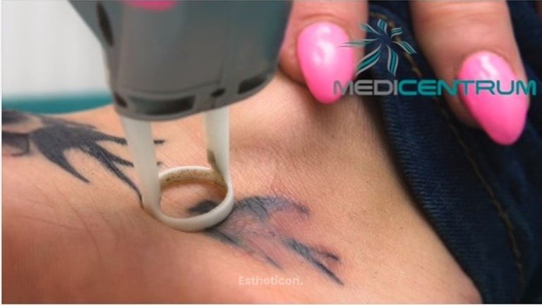 Odstraňovanie tetovania laserom