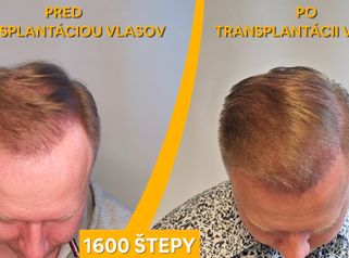 PHAEYDE Clinic - Transplantácia vlasov
