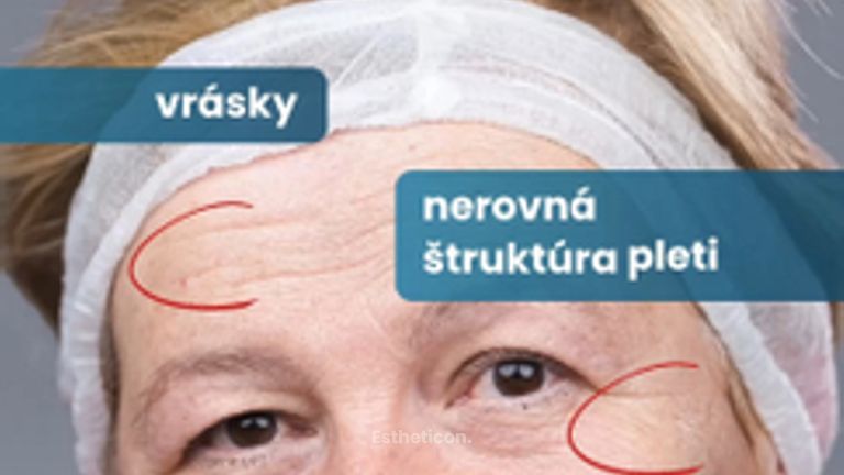 Laserový resurfacing a rejuvenizácia