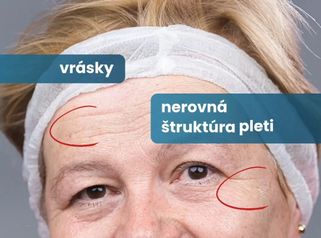 Laserový resurfacing a rejuvenizácia