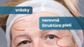 Laserový resurfacing a rejuvenizácia